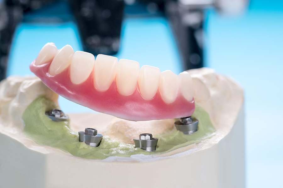 What Are Dental Implants?
