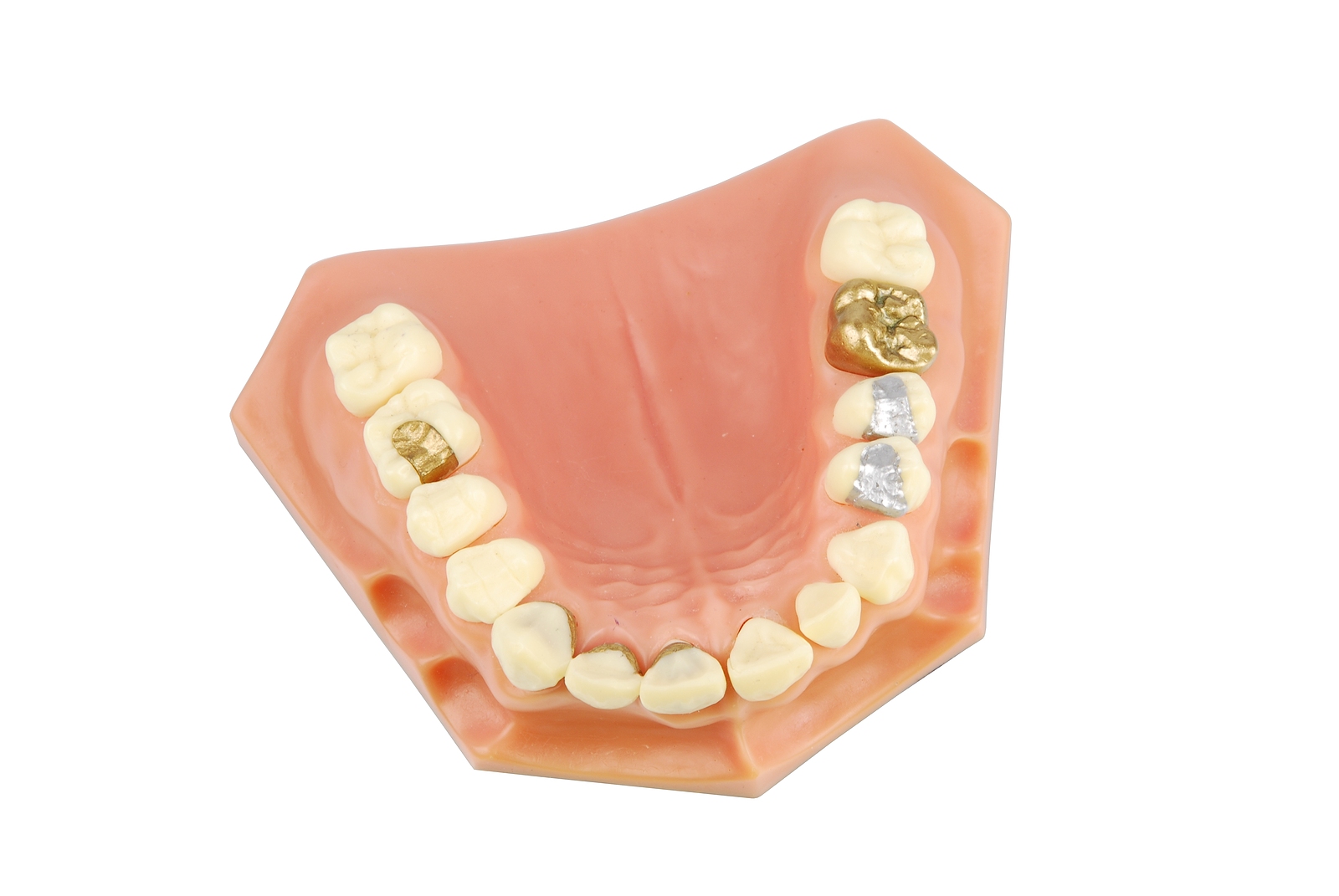 Restoring Your Smile with Modern Dental Fillings