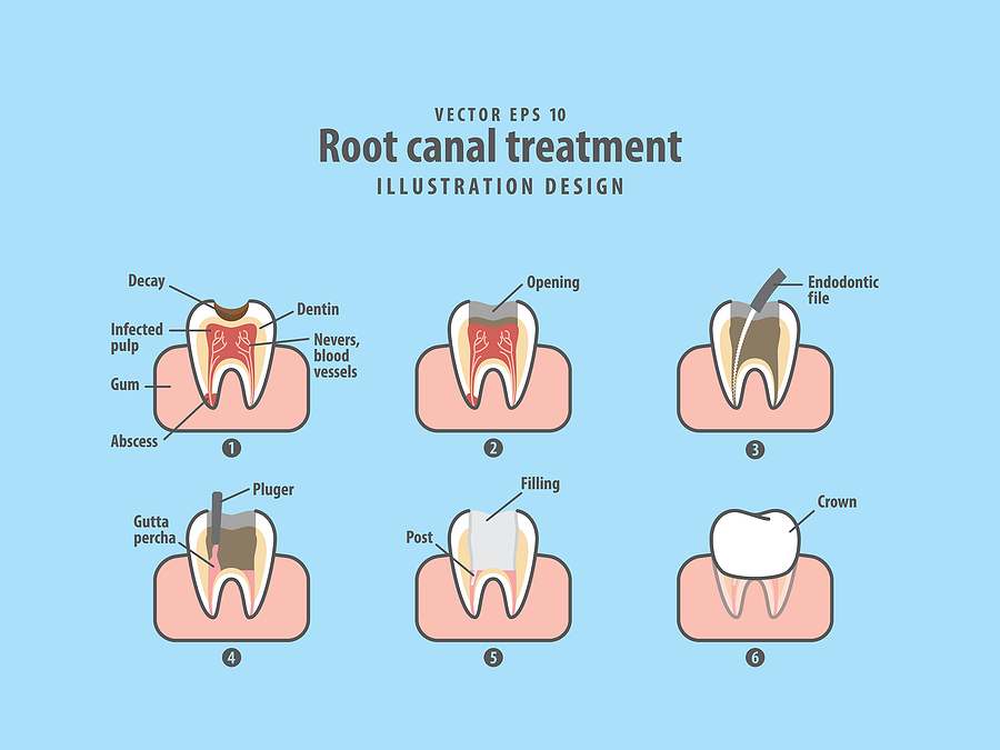 Root Canal Treatment: Preserving Your Natural Smile