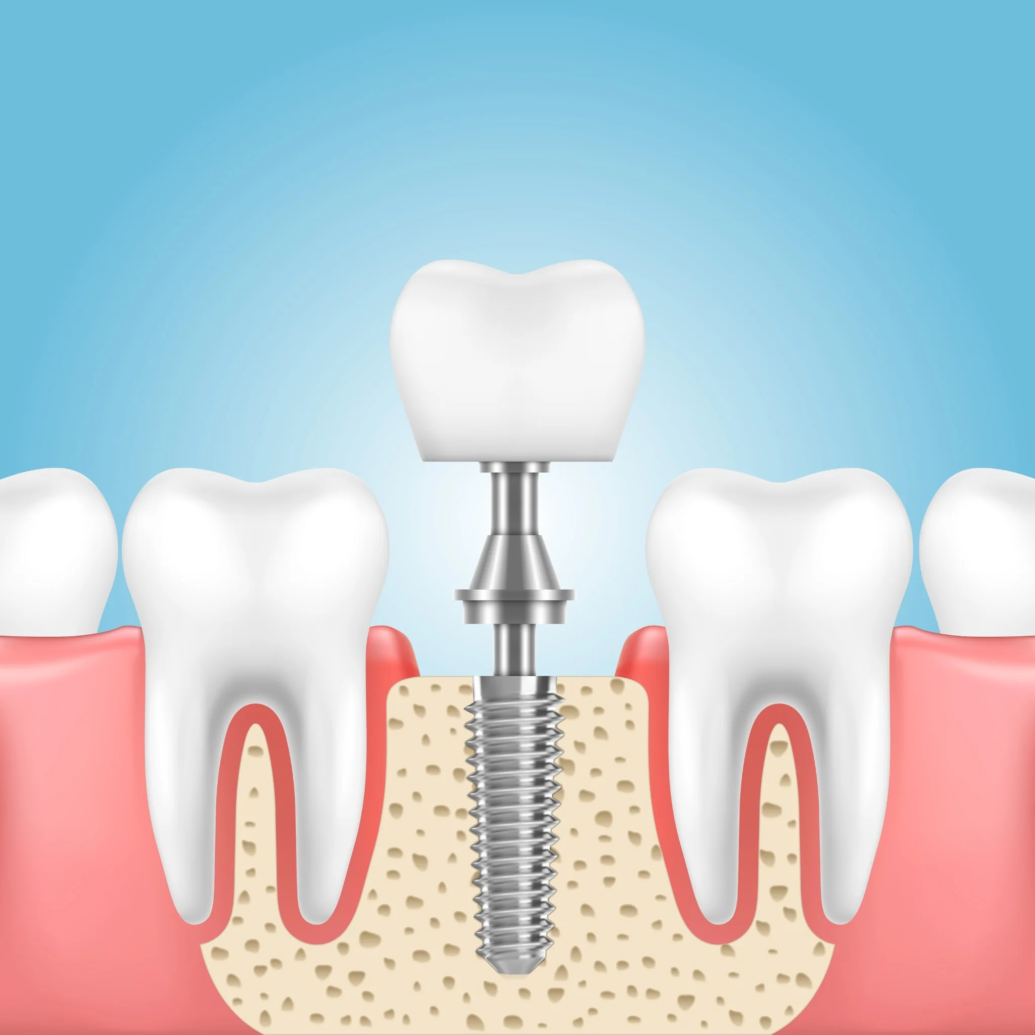 Dentistry The Dalles OR Dental Implant Model